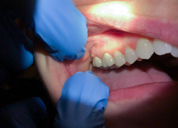 Best Emergency Denture Repair in Salem, OR