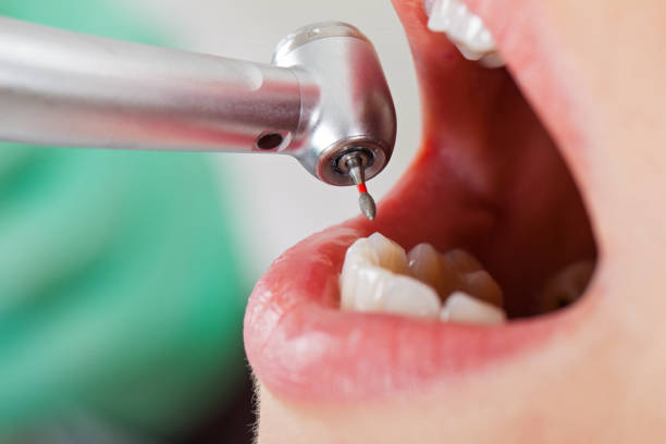 Best Urgent Care for Lost Fillings or Crowns in Salem, OR